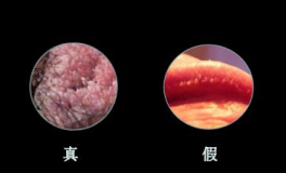 尖锐湿疣潜伏期症状,症状、危害及预防措施”